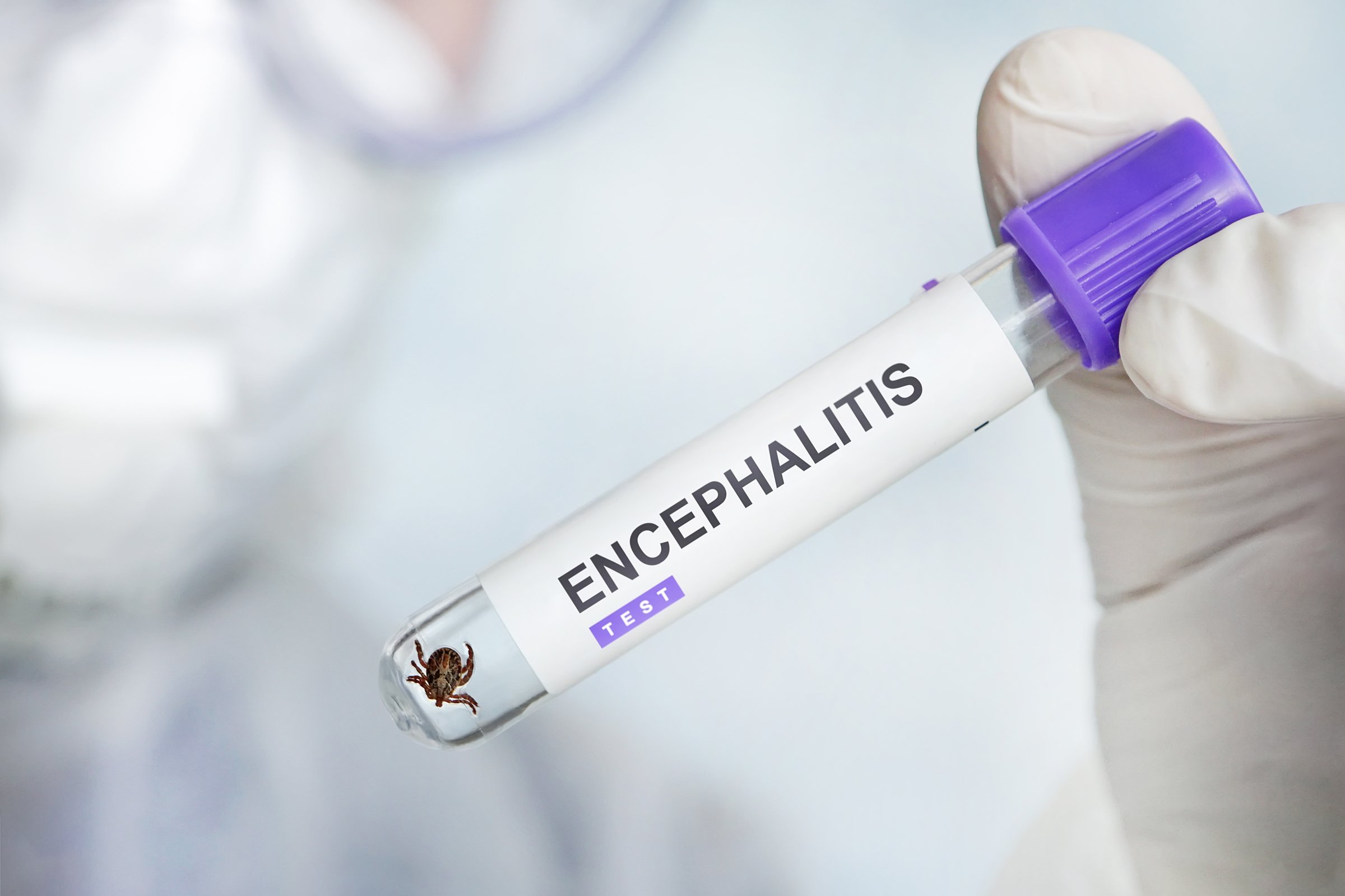 encephalitis