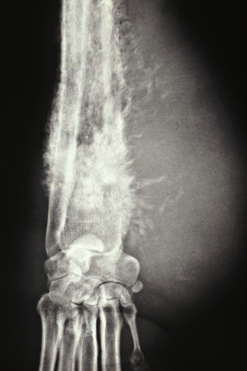 osteosarcoma röntgen csontrák csontdaganat
