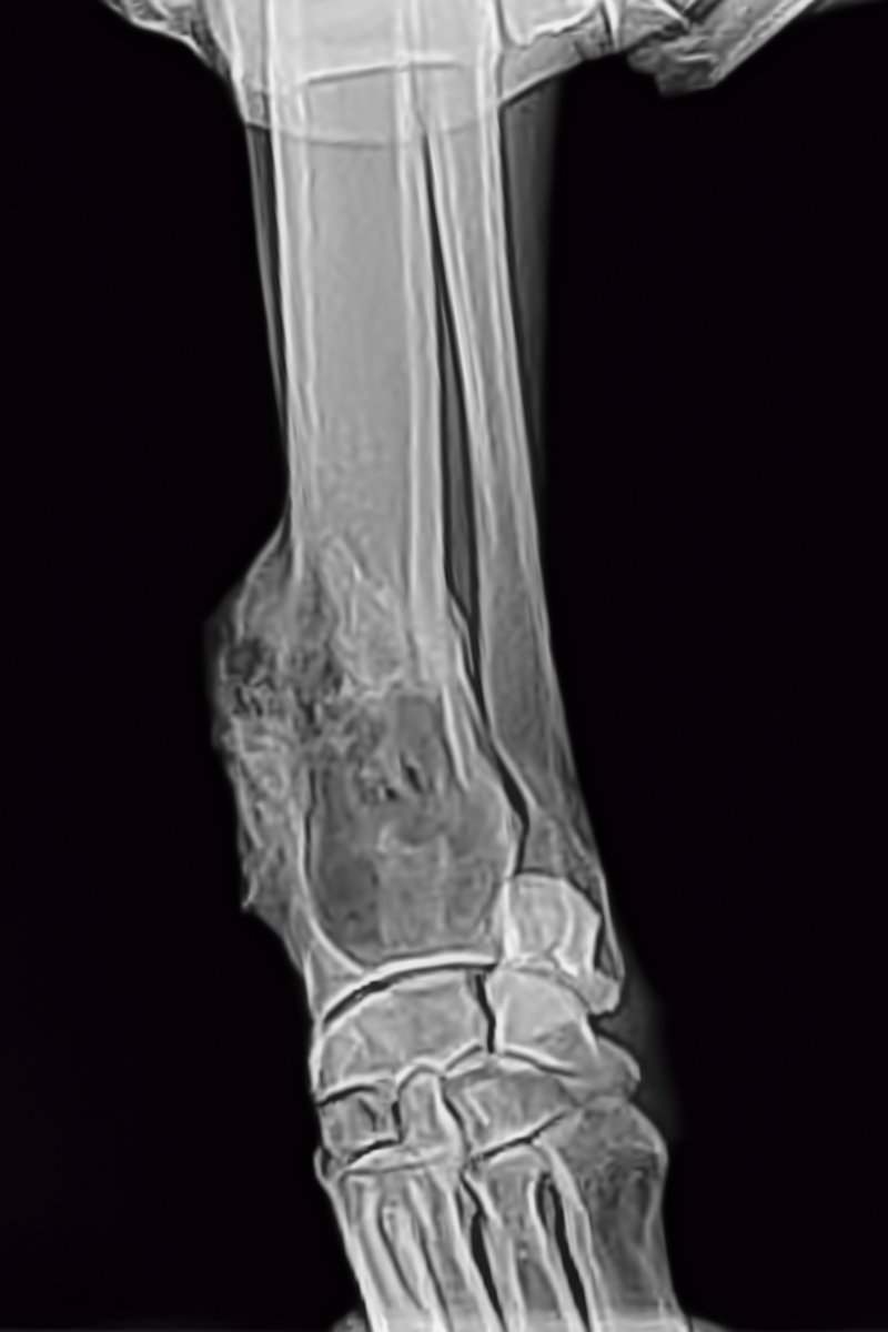 osteosarcoma röntgen csontrák csontdaganat
