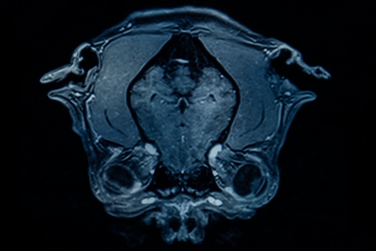 mri agy